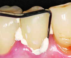 Luxatemp STAR - удаление излишков стоматологического цемента